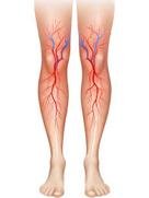 Bacak Damar Hastalığı Nedir